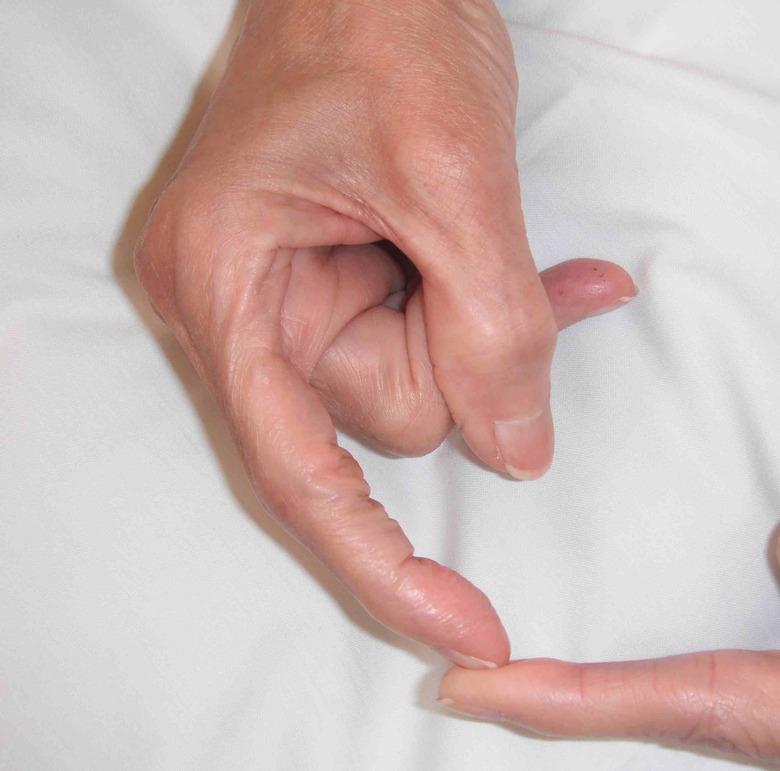 Rheumatoid Swan Neck Finger 1